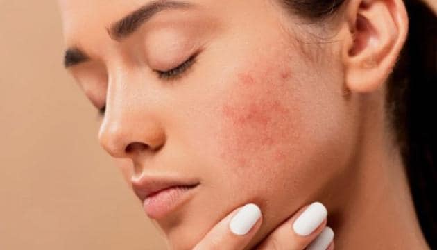 Studio Psiché Milano - Acne, il disagio sul corpo